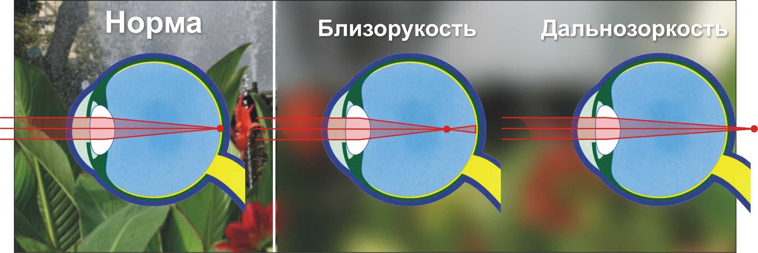 Если изображение фокусируется перед сетчаткой глаза то возникает