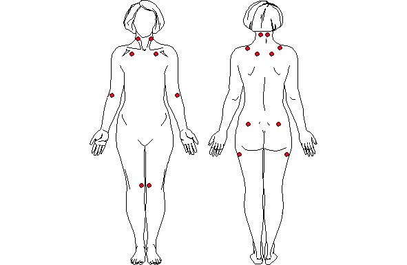 Рисунок 1. Иллюстрация точек из Диагностических критериев синдрома фибромиалгии Американского колледжа ревматологии от 1990 года.